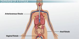 एनल फिस्ट्युला Enal fistula