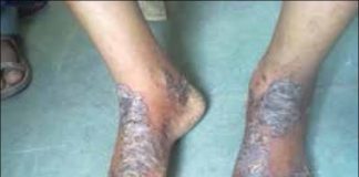 ‘इसब’-वाचा डॉ सोनाली सरनोबत यांच्या टिप्स Exima isab