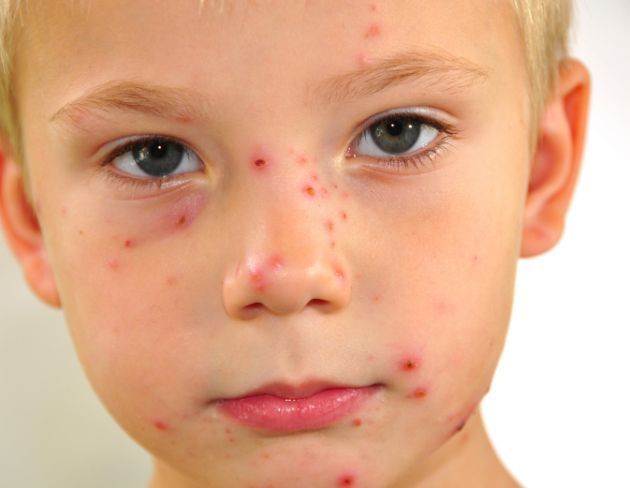 ‘कांजण्या-वाराफोड्या’