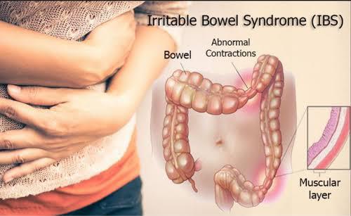Irritable bowell syndrome