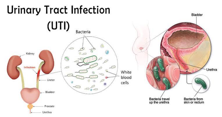 Uti