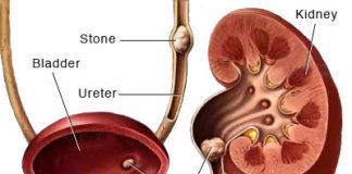 मुतखडा व त्यावरील उपाय Kidney stones