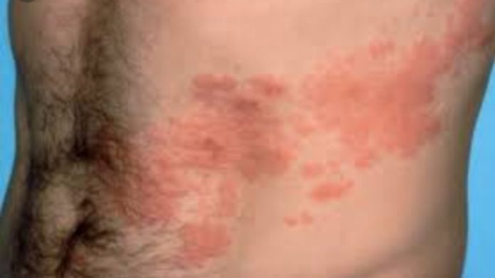 Harpes zoster nagin Harpes zoster nagin