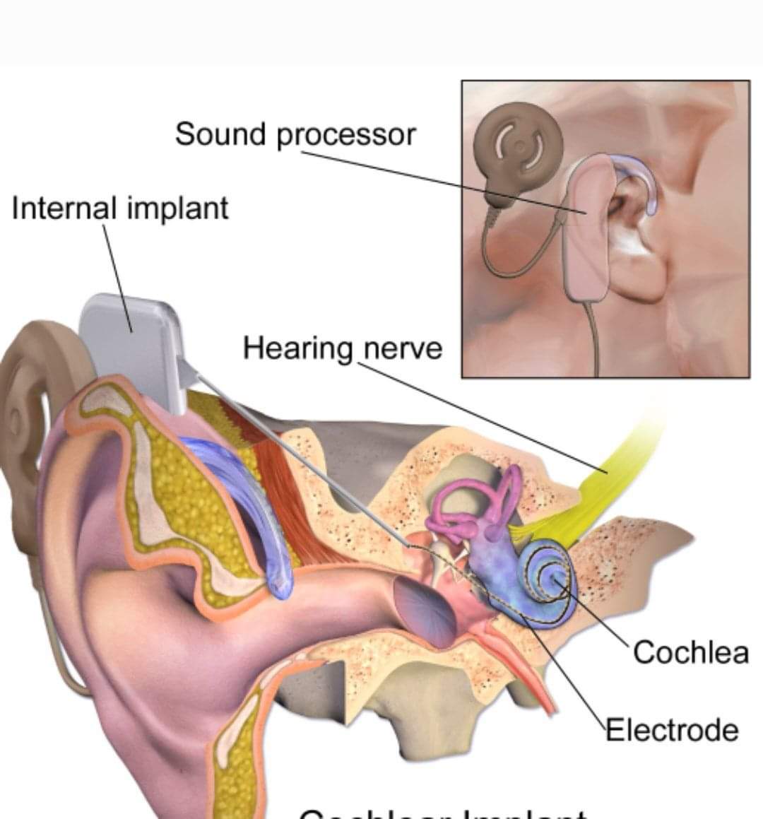 Cochlear Implant Surgeries