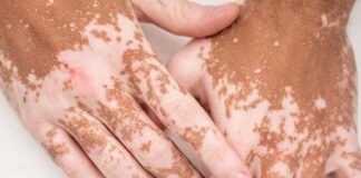 पांढरे डाग कोड : उपचार काय? White patch code