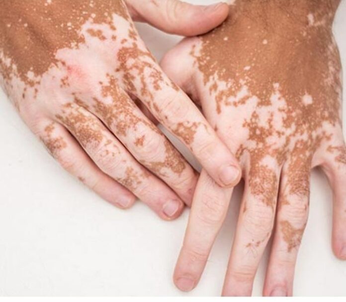 Code white patch White patch code