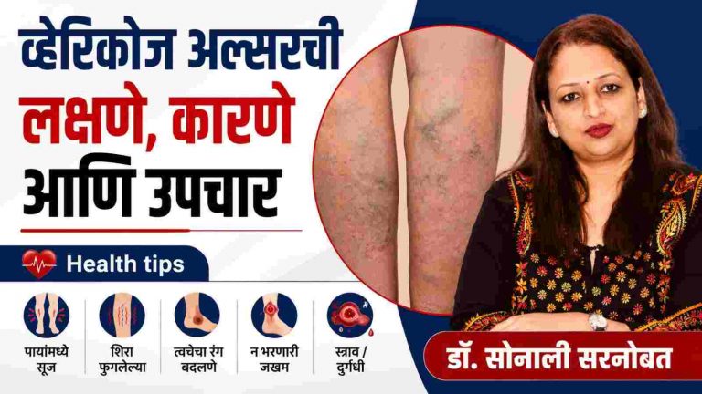 व्हेरिकोज अल्सर म्हणजे काय? त्यावर उपचार काय?