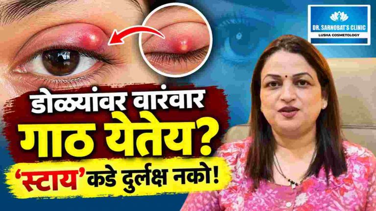 डोळ्यांवरील ‘स्टाय’कडे दुर्लक्ष नको; वारंवार होत असल्यास वैद्यकीय सल्ला घ्या